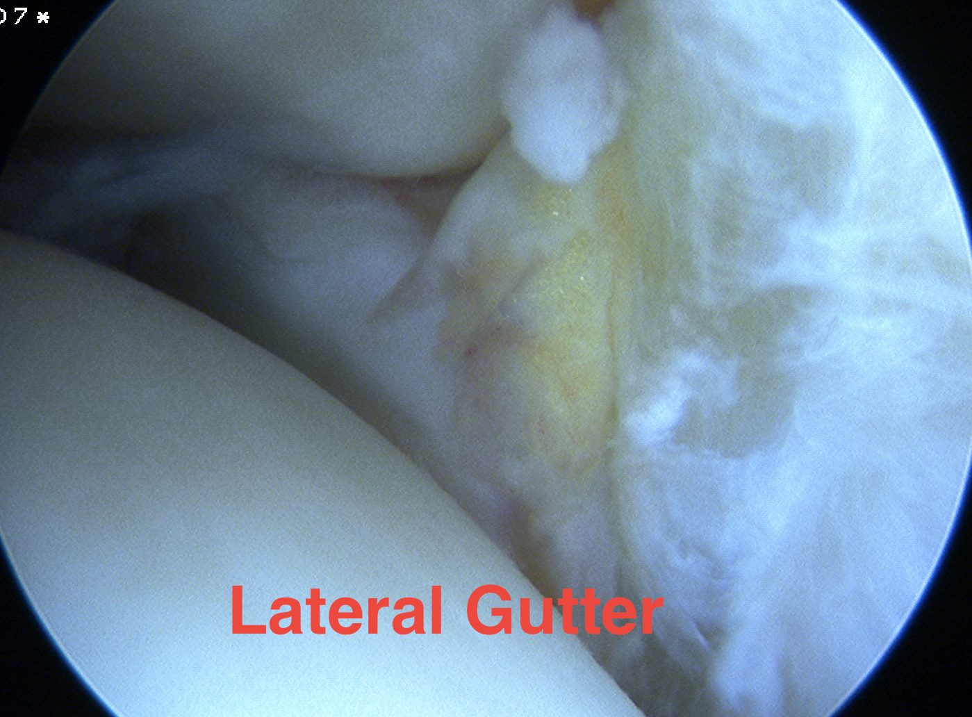 Ankle scope lateral gutter